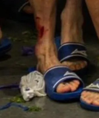 紅牌也不冤！被帕利尼亞蹬踏的波鴻球員，賽后小腿創(chuàng)口依然明顯